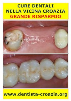 Dentisti Croazia - a 70 km da Trieste risparmi 50%